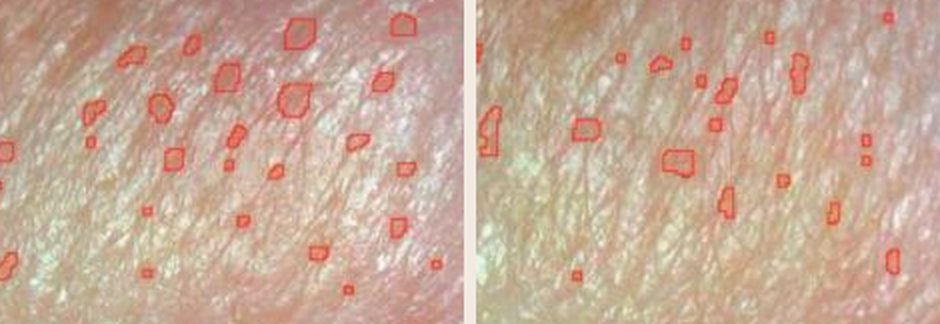 Skin pore measurement, dermatological imaging. Left: before. Right: after 4 weeks.