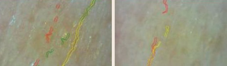 Wrinkle measurement, dermatological imaging. Left: before. Right: after 4 weeks.